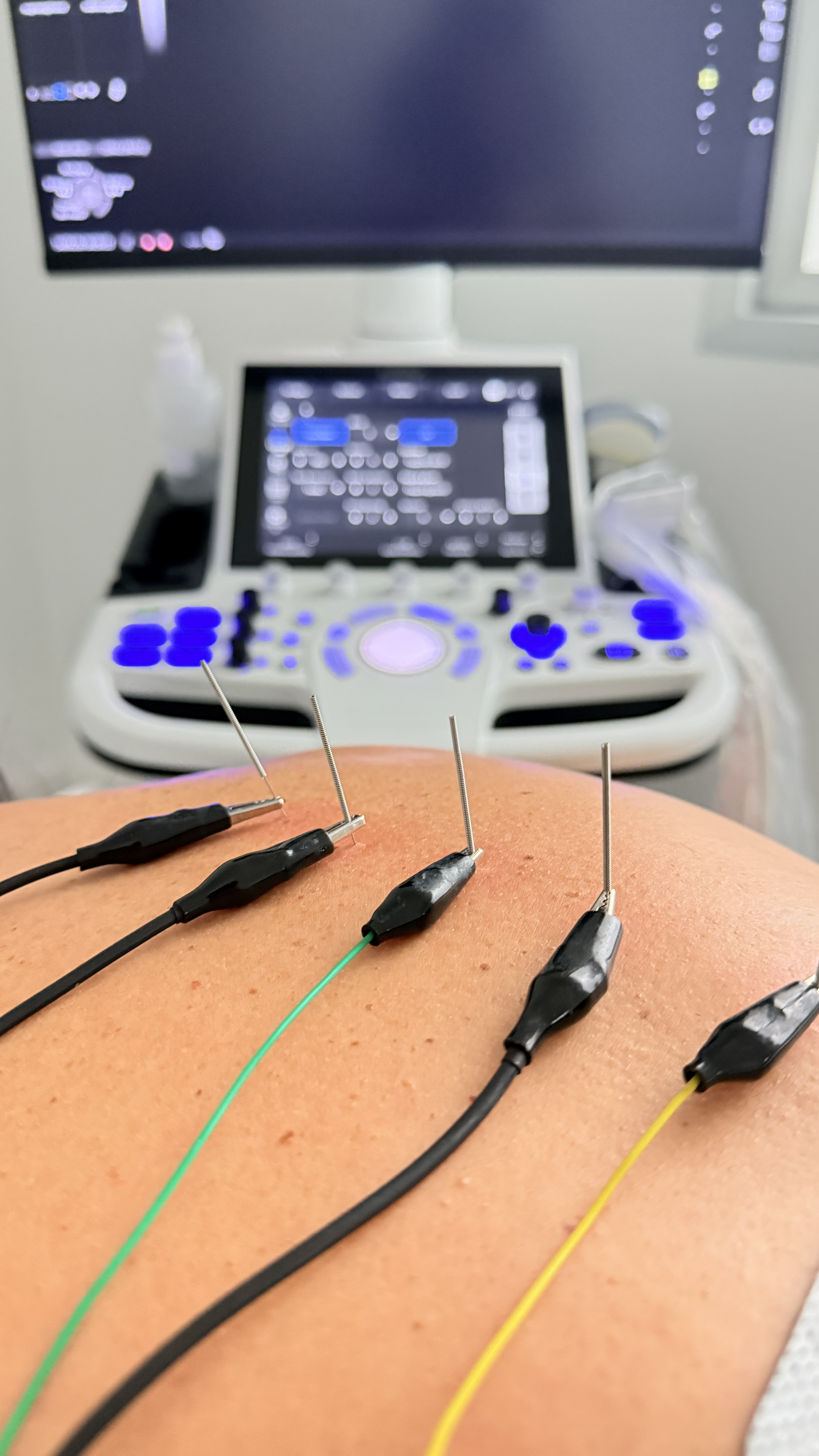 Tratamientos Ecoguiados — Neuromodulación percutánea AC Fisioterapia Avanzada Sevilla