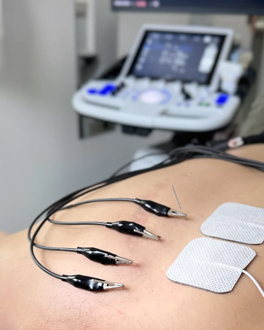 Sesi&oacute;n de fisioterapia invasiva con agujas y electrodos y el ec&oacute;grafo al fondo en AC Fisioterapia Avanzada, Sevilla